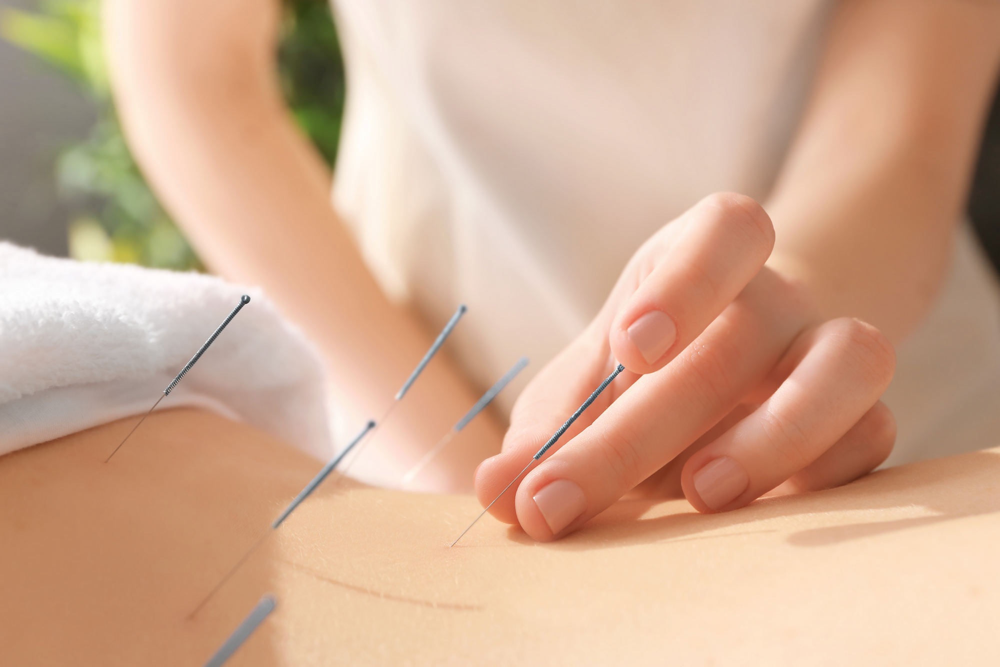 Acupuncture treatment